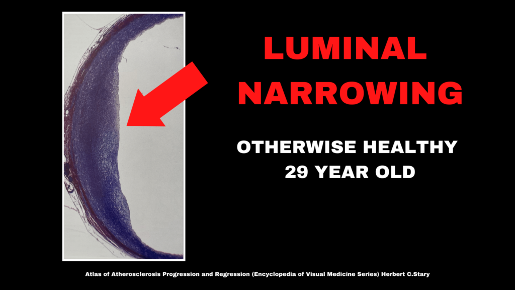 A cross section of early stage atherosclerosis in an otherwise healthy 29 year old.