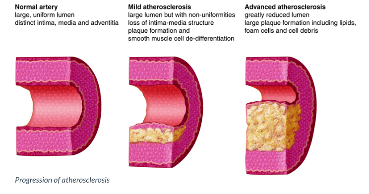 A cross section of three arteries showing normal to advanced atherosclerotic disease.