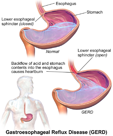 Diagram of what causes acid reflux cough.