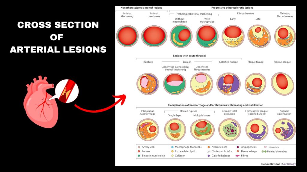 Cross seconds of arterial lesions and their classification. Graphics of each lesion. 