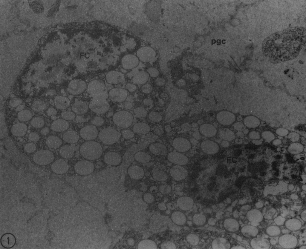 An electron photomicrograph of isolated macrophage foam cells in a 1-month old infant. 