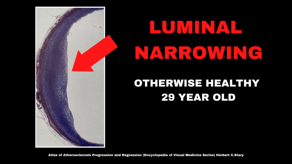 A cross section displaying arterial luminal narrowing in an otherwise healthy 29 year old.