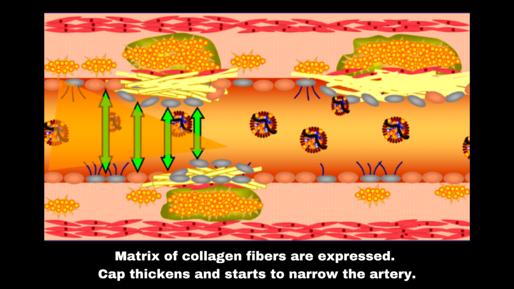 Collagen fibers being laid down in a matrix which causes the artery wall to narrow