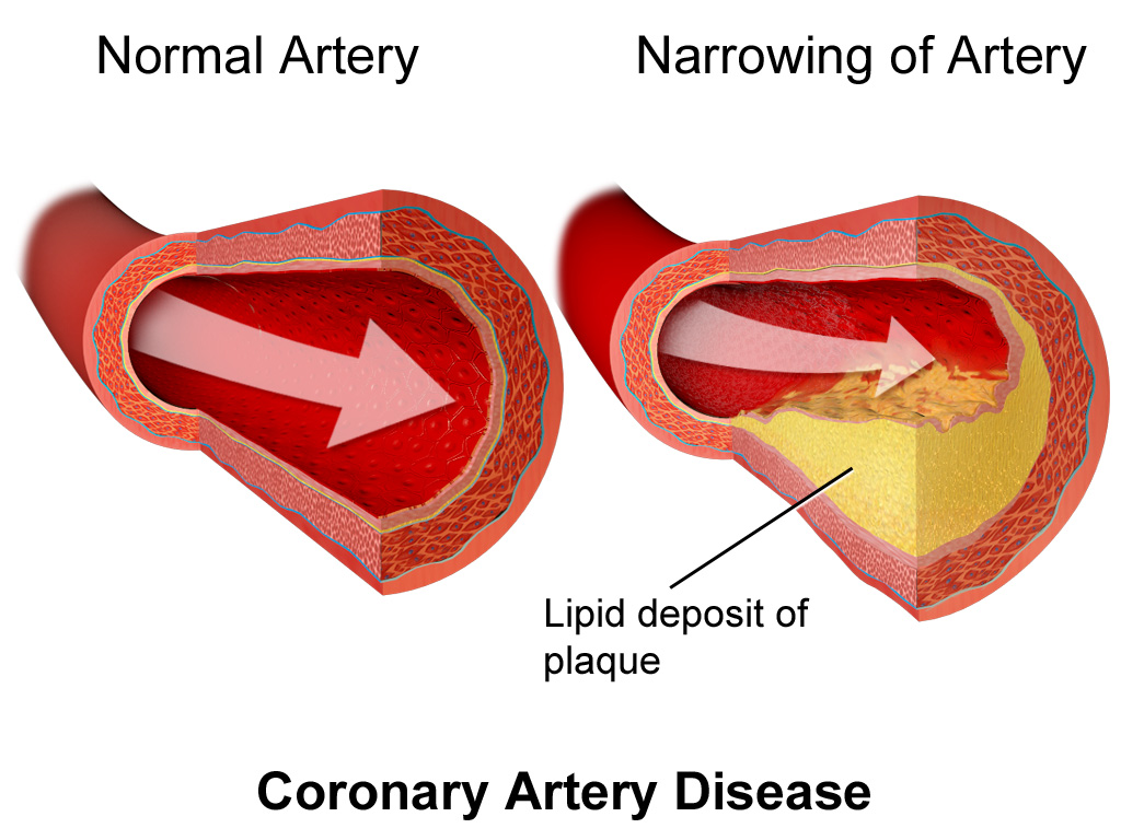 A graphic that shows a healthy artery and a diseased artery with plaque build up.