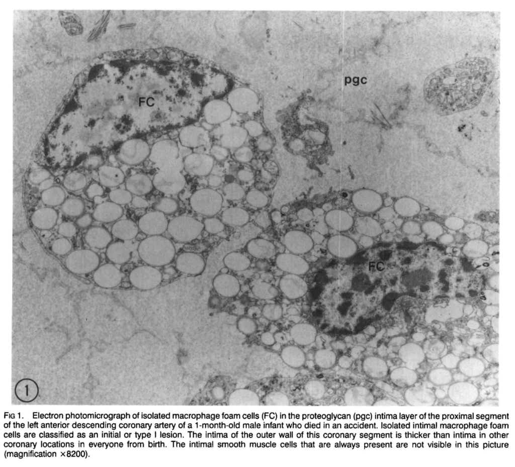 Electron photomicrograph of macrophage foam cells
