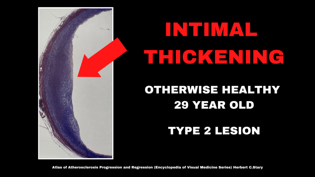 An arterial lesion which displays intimal thickening. 