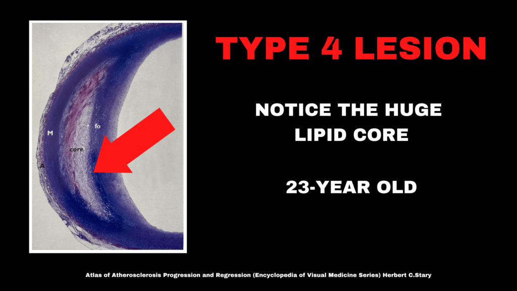 A type 4 arterial legion which displays a big lipid core.