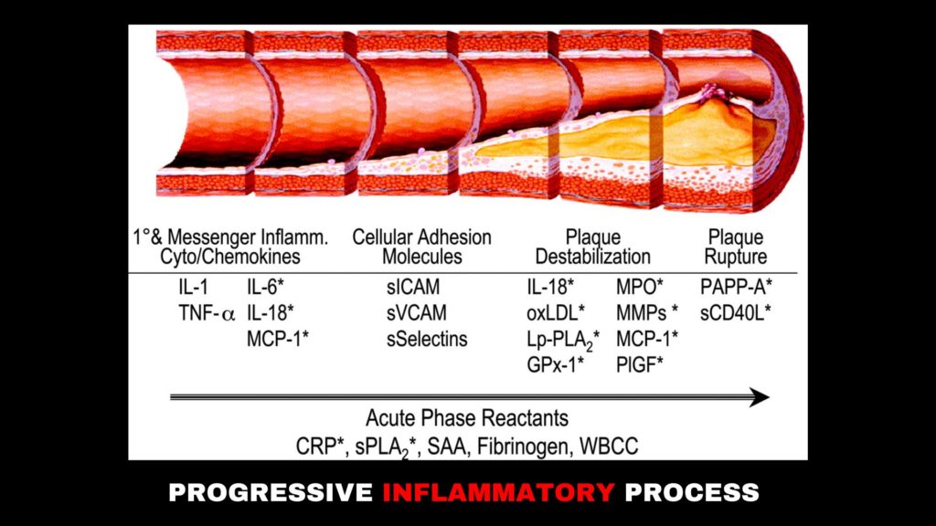 A graphic which shows the progressive inflammatory process of ASCVD. 